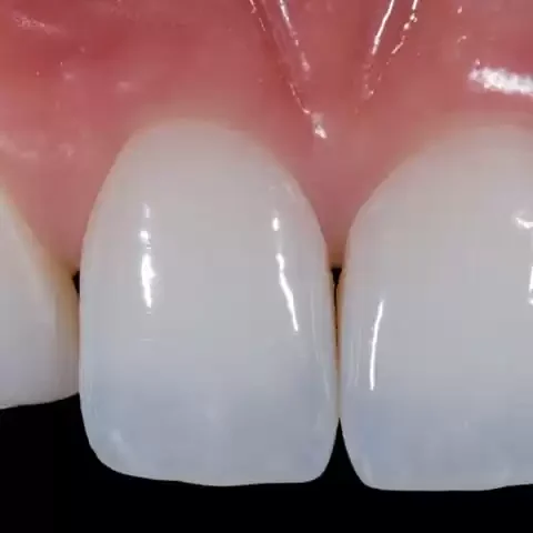 Facetas em Resina Direta