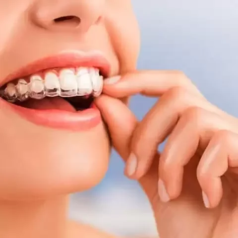 Ortodontia com Invisalign e Clear Correct